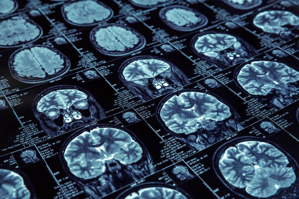 Nutrición y Suplementación para la Cognición, Neuroprotección y Prevención de Enfermedades Neurodegenerativas